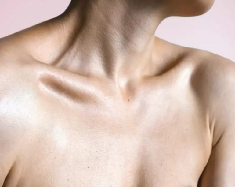 GC Aesthetics® medical illustration